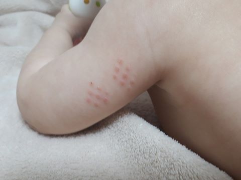 ハンコ注射の跡を消したい 自宅で消す方法はアットノンが最適 イナコド 田舎で子育てをしてます ハンコ注射の跡を消したい 自宅で消す方法はアットノンが最適 イナコド 田舎で子育てをしてます